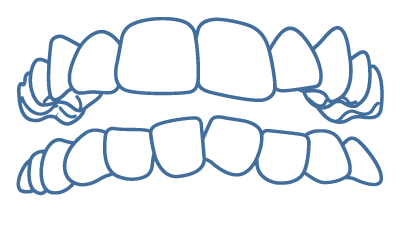 Dentes apinhados